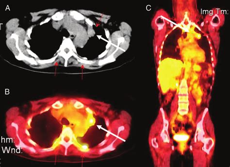 FDG-PET scan identification of a primary lung carcinoma in a patient ...