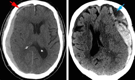 Acute Subdural Hematoma | The Neurosurgical Atlas