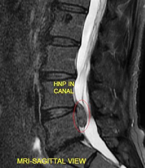 herniated nucleus pulposus Archives - Shim Spine