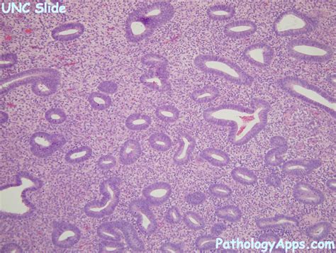 endometrial hyperplasia pathology