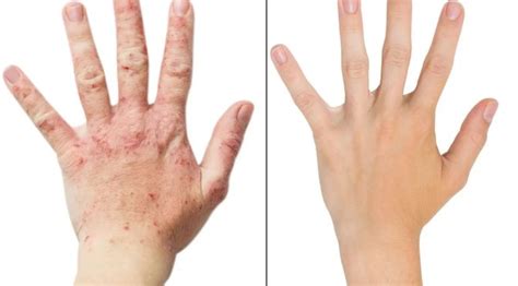 Dupixen Has Miraculously Cured My Eczema - The Skeptical Cardiologist