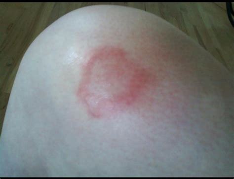 Lyme Disease Bullseye Skin Rash Tick Bite | Lyme Warrior | Lyme Warrior.