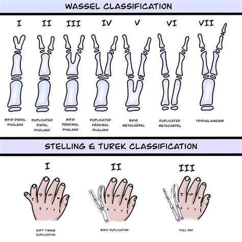 [Figure, Polydactyly Classifications. Preaxial and Postaxial ...