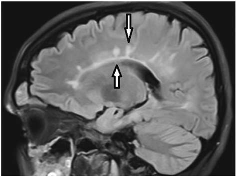 Signs in Neuroradiology: A Pictorial Review