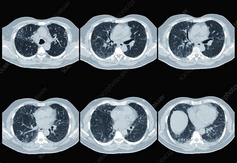 Interstitial lung disease, CT scan - Stock Image - C013/2184 - Science ...