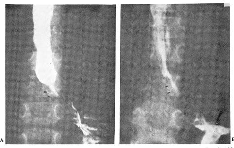 Figure 1 from Esophageal stenosis due to tracheobronchial remnants: a ...