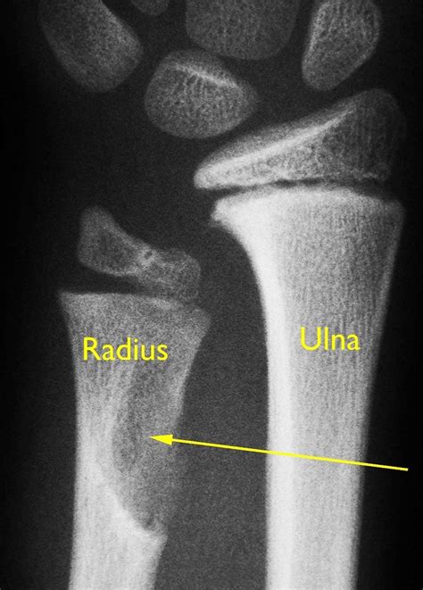 Periosteal and Soft Tissue Chondromas - OrthoInfo - AAOS