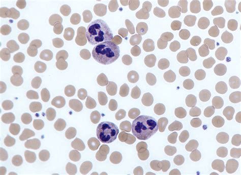 White Blood Cell Inclusions and Abnormalities - HEMATOLOGY