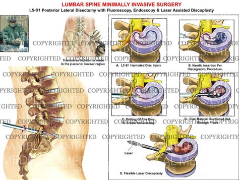 L5-S1 Lumbar posterior minimally invasive surgery — Medical Art Works