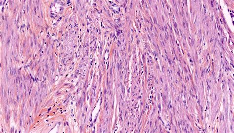 Pathology Outlines - Leiomyoma-general