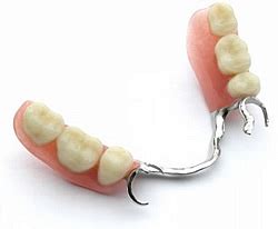 Liberty Dental Tijuana | Metal Frame Partial Denture