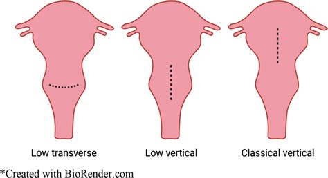 Types of cesarean section surgical incisions. Diagram depicts several ...