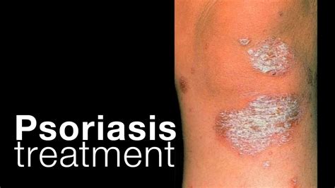 Psoriasis: treatment options + related issues - YouTube