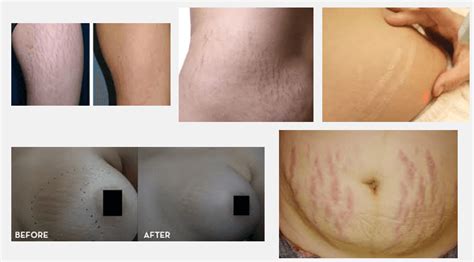 Laser Stretch Mark Removal: The Advanced Way of Removing Stretch Marks