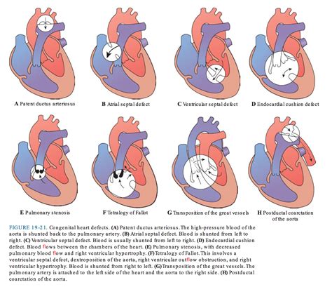 Advanced Pathophysiology - Congenital Heart Defects | Congenital heart ...