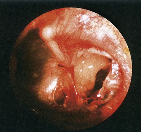 Perforated Tympanic Membrane (Ruptured Eardrum) | Anesthesia Key