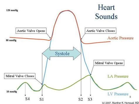 Heart Sounds description | Nursing & Nursing School :) | Pinterest ...