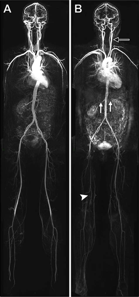 High prevalence of atherosclerosis found in lower risk patients