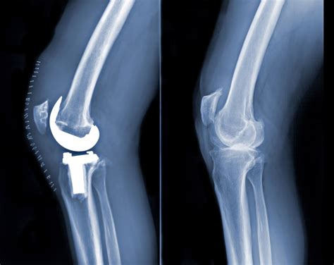 Total Knee Replacement for Osteoarthritis: Benefits and Cost-Effectiveness