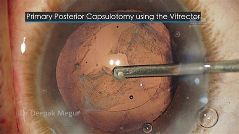 Primary Posterior Capsulotomy by using a vitrector- The Secrets- Dr ...