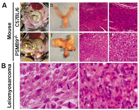 Figure 1. | Molecular Pathology and Novel Clinical Therapy for Uterine ...