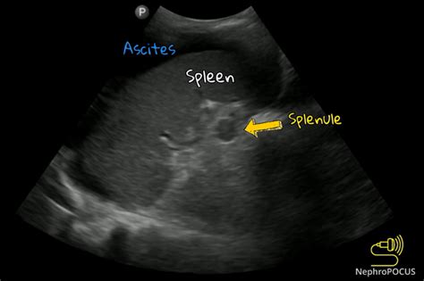 Accessory Spleen – NephroPOCUS