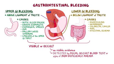 Upper GI Bleeding In the ED – Pedmore Medical