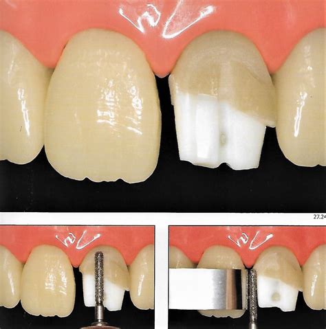 Anterior Crown Preparation | Dental Esthetics