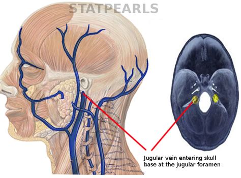 Jugular Foramen Syndrome - StatPearls - NCBI Bookshelf