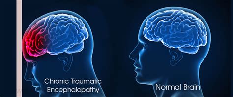 Chronic Traumatic Encephalopathy - Causes, Symptoms, Diagnosis ...