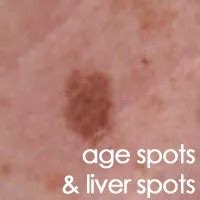 Old Age Spots on Face - Aimee's Skin Care Solutions