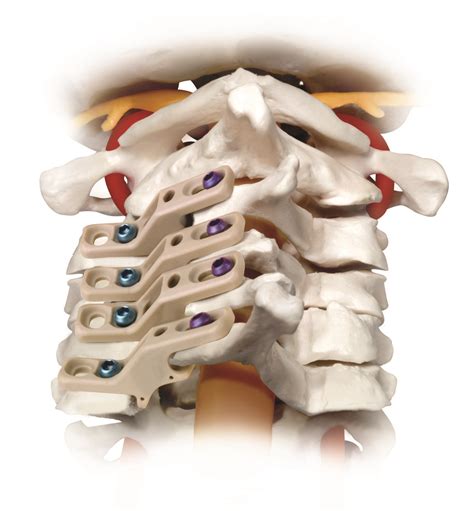 RELIEVE™ Radiolucent Laminoplasty System | Globus Medical