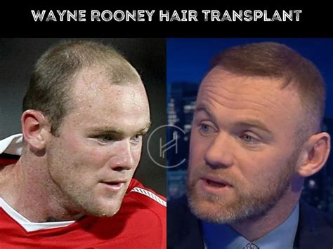 Wayne Rooney Hair Transplant - Hair Loss & Technical Analysis