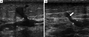 Minimally invasive treatments for perforator vein insufficiency ...