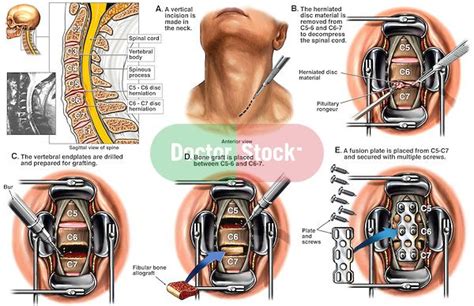 Spine Surgery - C5-6 and C6-7 Anterior Cervical Discectomy with Spinal ...