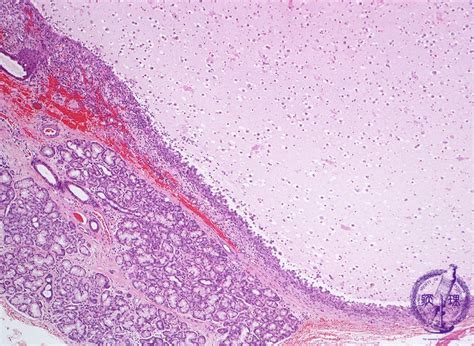 Mucocele Histology