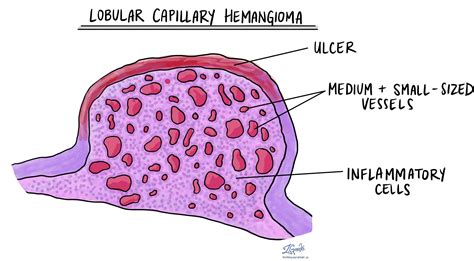 Lobular capillary hemangioma - MyPathologyReport.ca