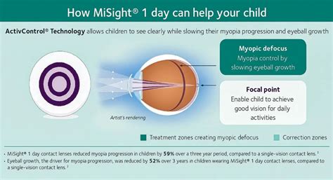 Myopia Control - Ban UK Optometrist