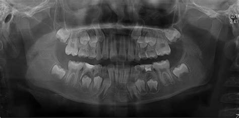 Periapical Abscess Radiograph