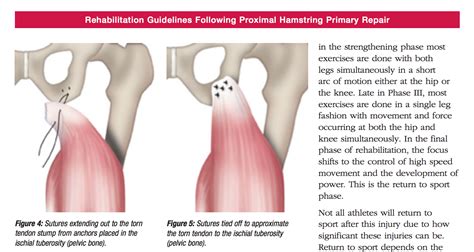 Hamstring Tendon Surgery