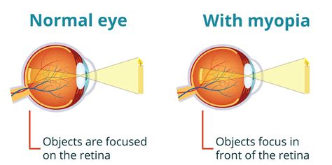 Myopia - The Eye Practice