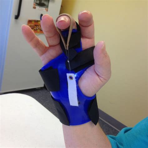 53 best images about OT- Splint on Pinterest | Hand therapy ...