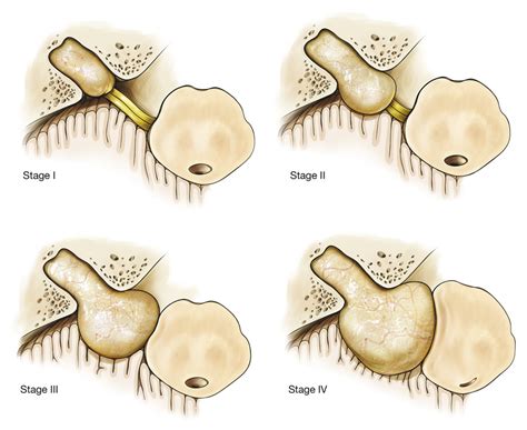 73 Management of Small Vestibular Schwannoma in Patients with Minimal ...