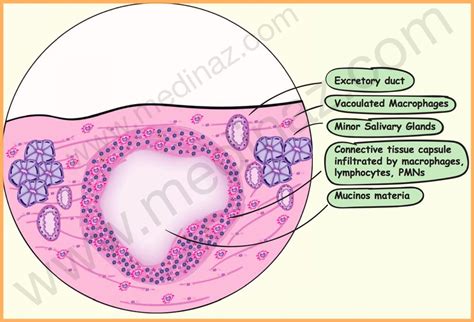 Oral Mucocele: Illustrated High Yield Dental Notes - Medinaz