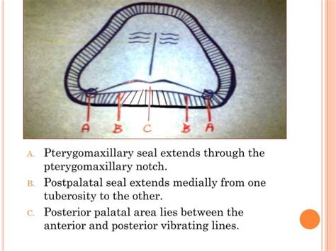 The posterior palatal seal | PPT