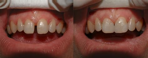 Gaps in Your Teeth and Why Bonding May Do The Trick - LA Dental Clinic