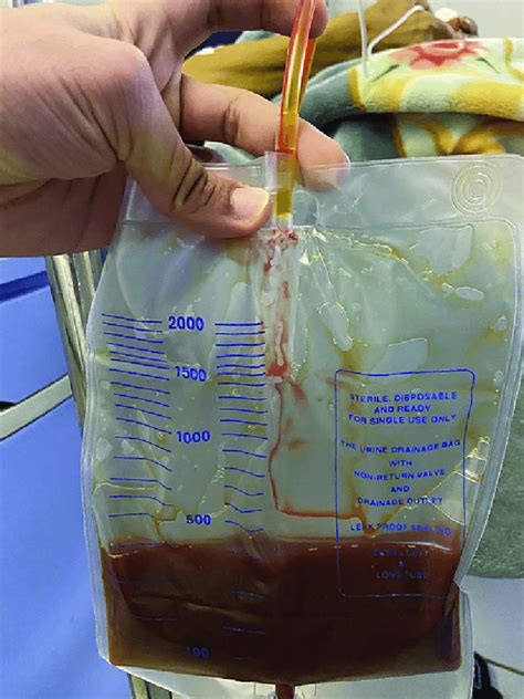 Photograph of the purulent biliary fluid obtained after the drainage ...