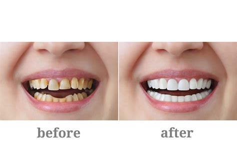 Porcelain Crowns & Porcelain Bonded Crowns - Treatment, Care & Advice