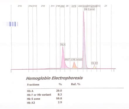 Hemoglobin Electrophoresis Sickle Cell