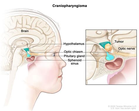 Childhood Craniopharyngioma Treatment (PDQ®)–Patient Version - Siteman ...